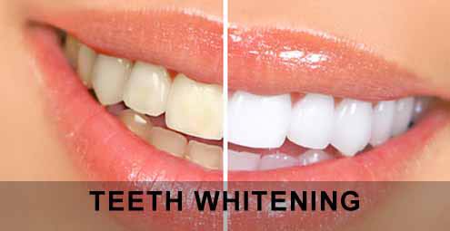 Professional teeth whitening results at Middlewich Street Dental in Crewe.