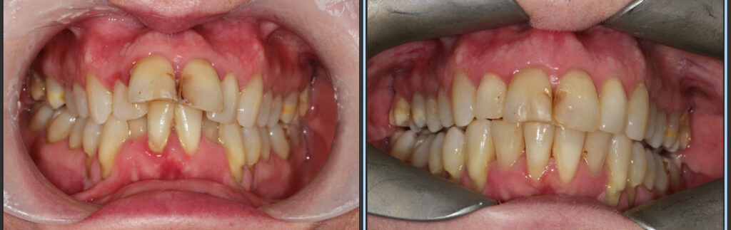 Case Study: Correcting severe crowding with Invisalign in Crewe
