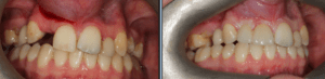 Side-by-side intraoral photos showing a before and after replacement of a missing upper right lateral incisor (UR2) using a two-unit cantilever dental bridge at Middlewich Street Dental Practice.